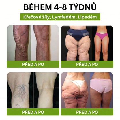 Luxarise®🌿Glumasetide 8v1 Stihla a zdrava nano mikrojehlickova naplast(1krát denně – viditelné změny až za 7 dní) ✅Pro obezitu, zpevnění kůže, cukrovku, spánkovou apnoe, klouby atd.